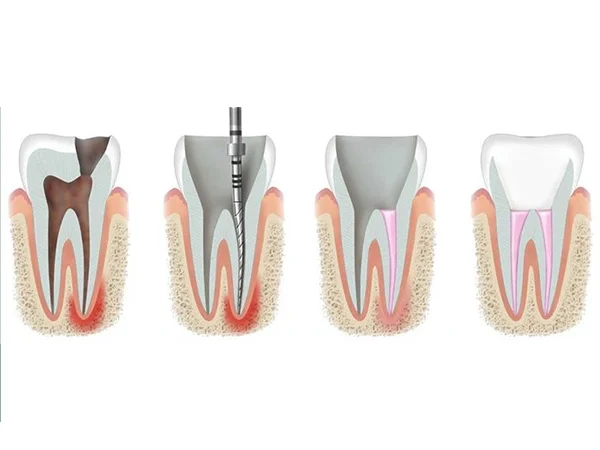 Root Canal Treatment