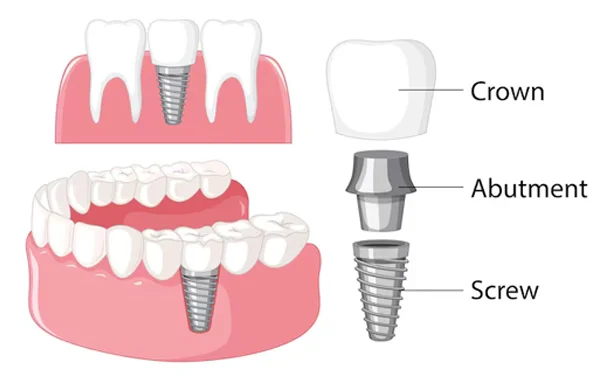 Dental Implants