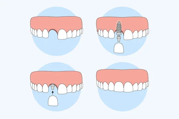 Missing Tooth Replacement