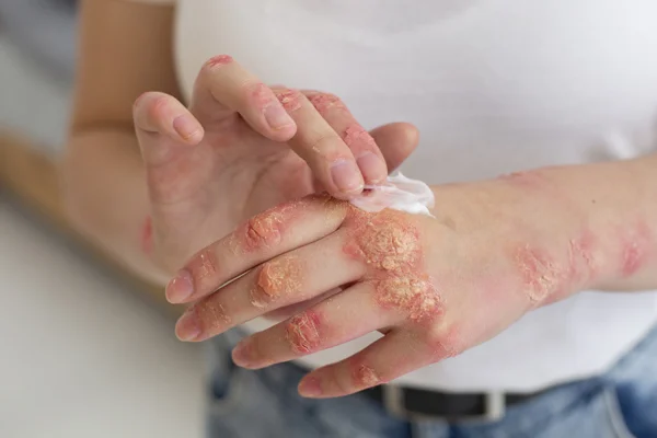 Fungal Infections